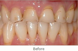 Before: Patient needs Upper Arch Rehabilitation. Presents with Upper Anterior teeth that are stained, incisal edges (tooth edge) are worn down and chipped, and gumline recession is present.