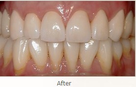 After: Smile restored with placement of 8 Upper All Porcelain Crowns (Caps). Gumline and incisal edges are now uniform. Patient now has longer, better shaped teeth to enhance the smile line and aid in chewing/biting function.