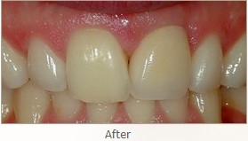 After: Smile and function restored with a Single Implant and an All Porcelain Crown (Cap) that fits securely over the implant.